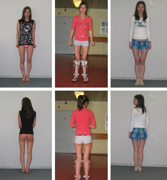 Кривые Ноги У Девушек Фото Как Исправить